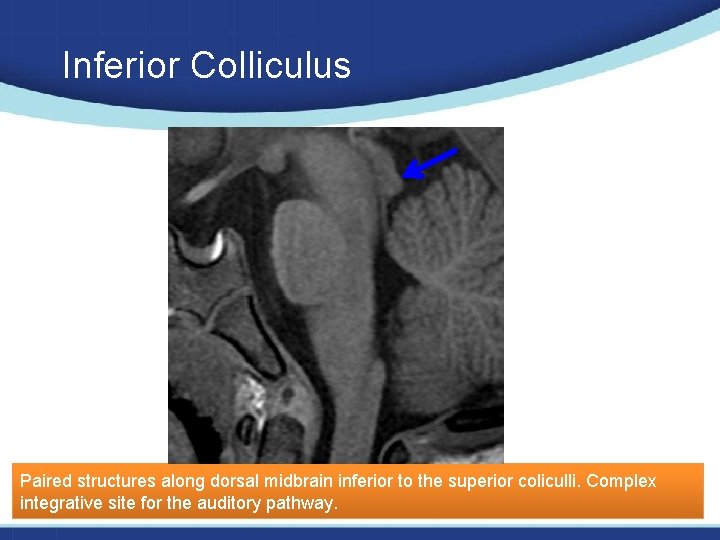 Inferior Colliculus Paired structures along dorsal midbrain inferior to the superior coliculli. Complex integrative