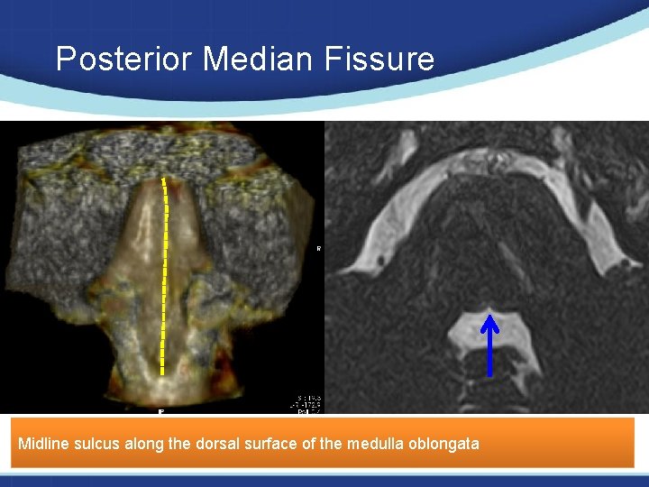 Posterior Median Fissure Midline sulcus along the dorsal surface of the medulla oblongata 