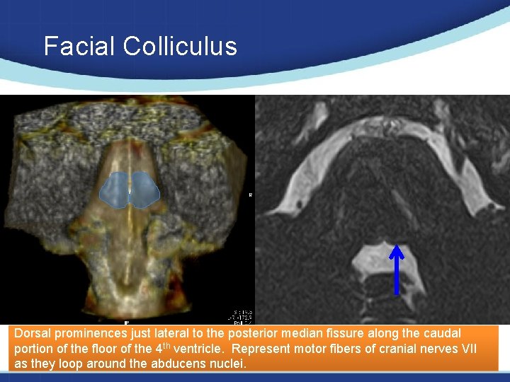Facial Colliculus Dorsal prominences just lateral to the posterior median fissure along the caudal