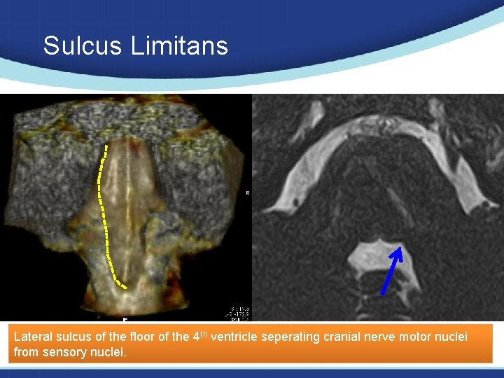 Sulcus Limitans Lateral sulcus of the floor of the 4 th ventricle seperating cranial