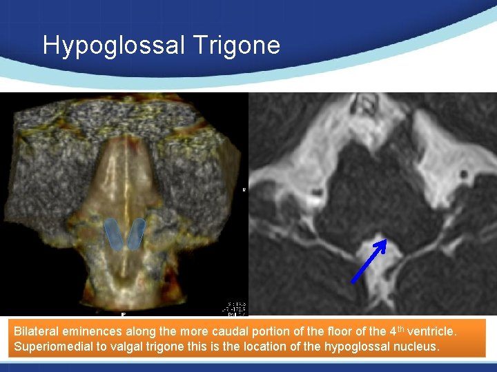 Hypoglossal Trigone Bilateral eminences along the more caudal portion of the floor of the