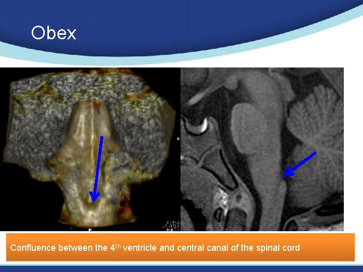 Obex Confluence between the 4 th ventricle and central canal of the spinal cord