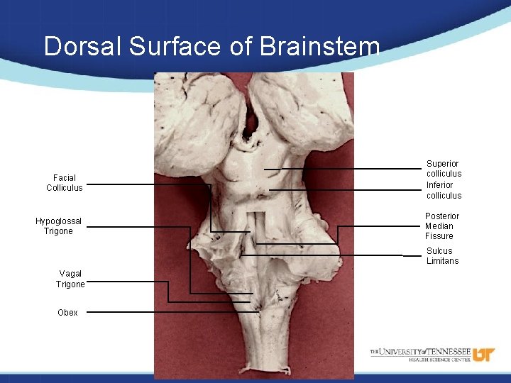 Dorsal Surface of Brainstem Facial Colliculus Superior colliculus Inferior colliculus Hypoglossal Trigone Posterior Median