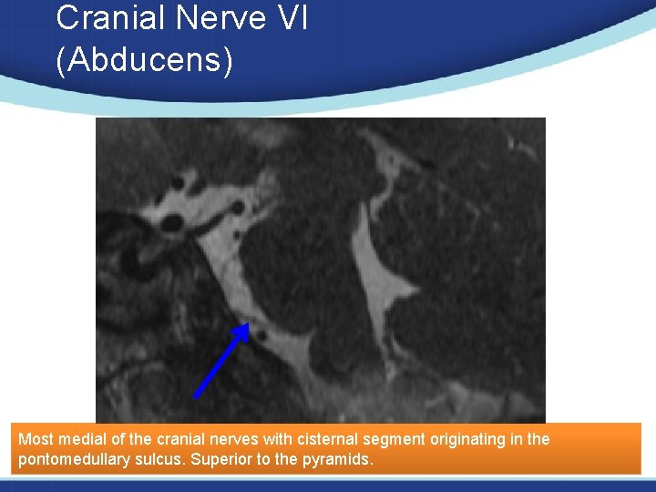 Cranial Nerve VI (Abducens) Most medial of the cranial nerves with cisternal segment originating