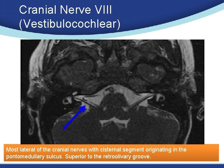 Cranial Nerve VIII (Vestibulocochlear) Most lateral of the cranial nerves with cisternal segment originating