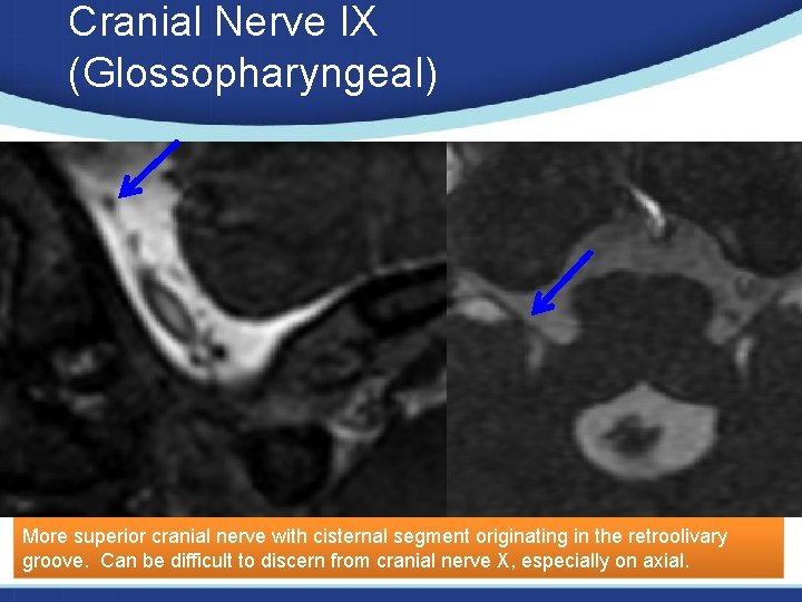 Cranial Nerve IX (Glossopharyngeal) More superior cranial nerve with cisternal segment originating in the