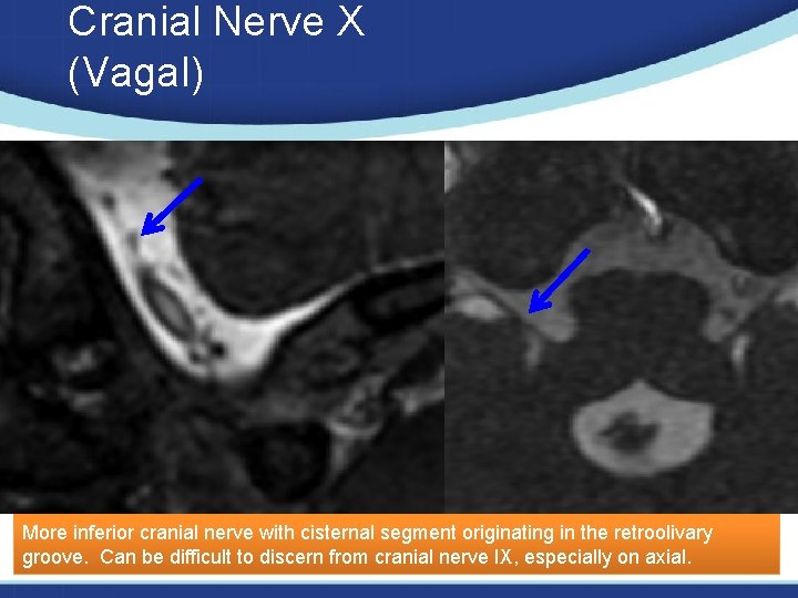 Cranial Nerve X (Vagal) More inferior cranial nerve with cisternal segment originating in the