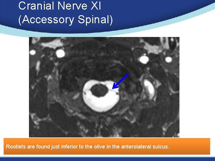 Cranial Nerve XI (Accessory Spinal) Rootlets are found just inferior to the olive in