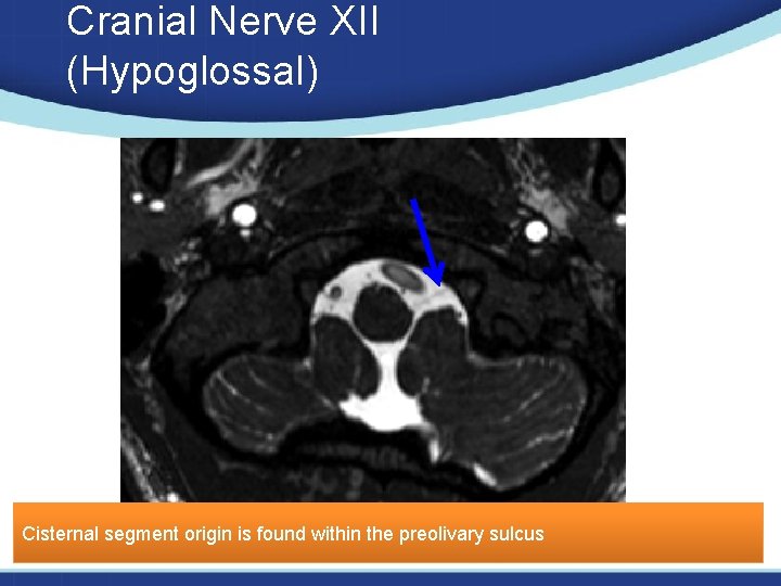 Cranial Nerve XII (Hypoglossal) Cisternal segment origin is found within the preolivary sulcus 