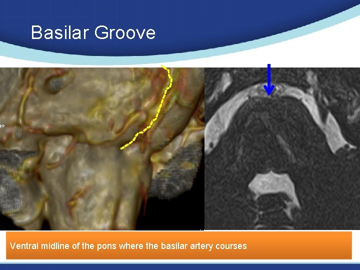 Basilar Groove Ventral midline of the pons where the basilar artery courses 