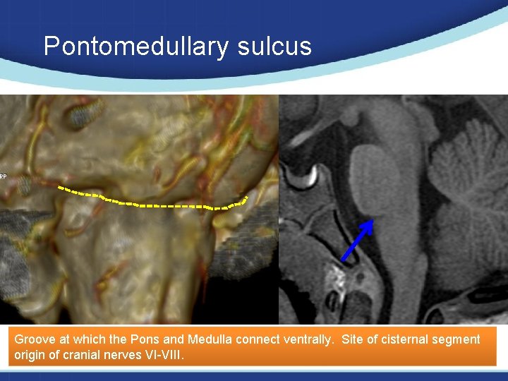 Pontomedullary sulcus Groove at which the Pons and Medulla connect ventrally. Site of cisternal