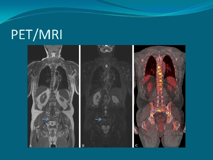 PET/MRI 