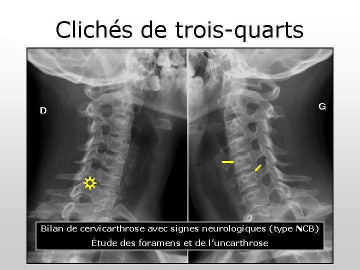 Clichés de trois-quarts Bilan de cervicarthrose avec signes neurologiques (type NCB) Étude des foramens Clichés de trois-quarts Bilan de cervicarthrose avec signes neurologiques (type NCB) Étude des foramens