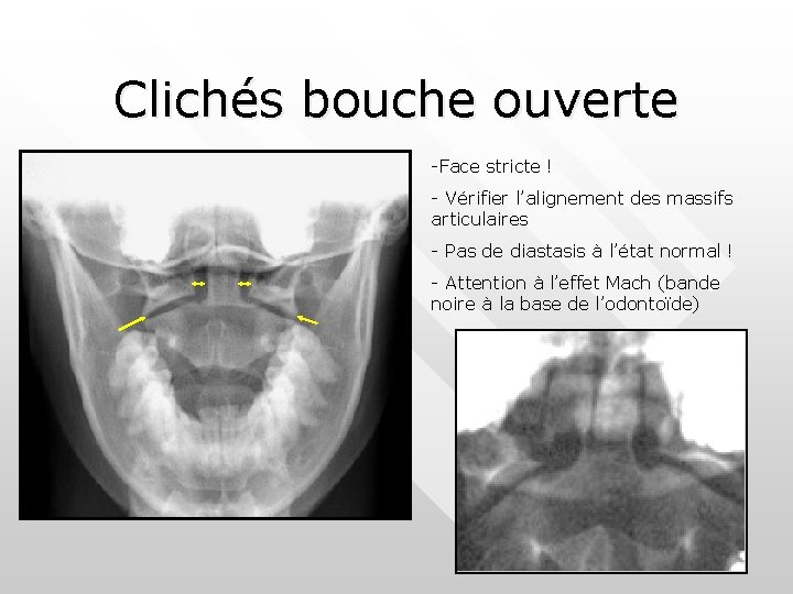 Clichés bouche ouverte -Face stricte ! - Vérifier l’alignement des massifs articulaires - Pas Clichés bouche ouverte -Face stricte ! - Vérifier l’alignement des massifs articulaires - Pas