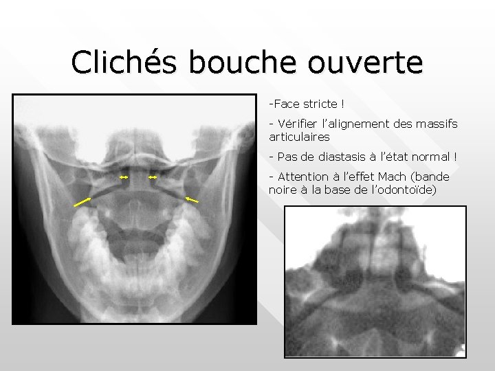 Clichés bouche ouverte -Face stricte ! - Vérifier l’alignement des massifs articulaires - Pas