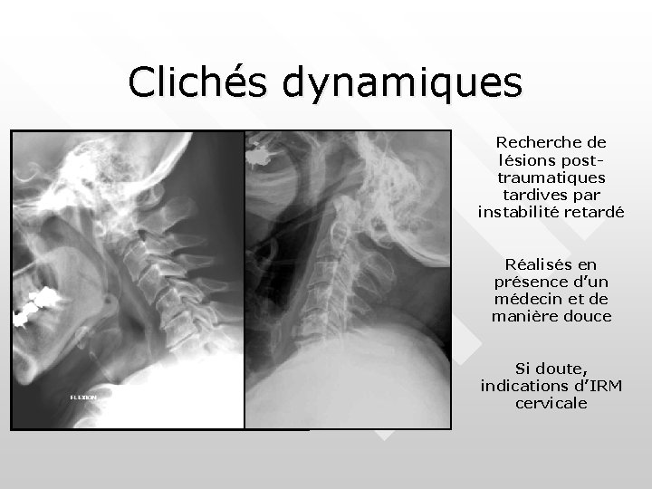 Clichés dynamiques Recherche de lésions posttraumatiques tardives par instabilité retardé Réalisés en présence d’un