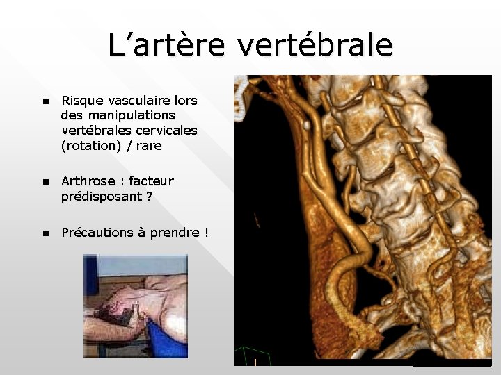 L’artère vertébrale n Risque vasculaire lors des manipulations vertébrales cervicales (rotation) / rare n L’artère vertébrale n Risque vasculaire lors des manipulations vertébrales cervicales (rotation) / rare n