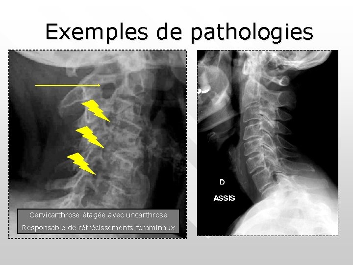 Exemples de pathologies Cervicarthrose étagée avec uncarthrose Responsable de rétrécissements foraminaux Exemples de pathologies Cervicarthrose étagée avec uncarthrose Responsable de rétrécissements foraminaux