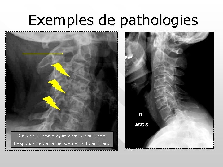 Exemples de pathologies Cervicarthrose étagée avec uncarthrose Responsable de rétrécissements foraminaux 