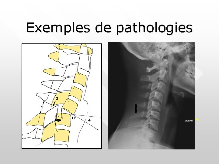 Exemples de pathologies mm 11° ENTORSE BENIGNE 