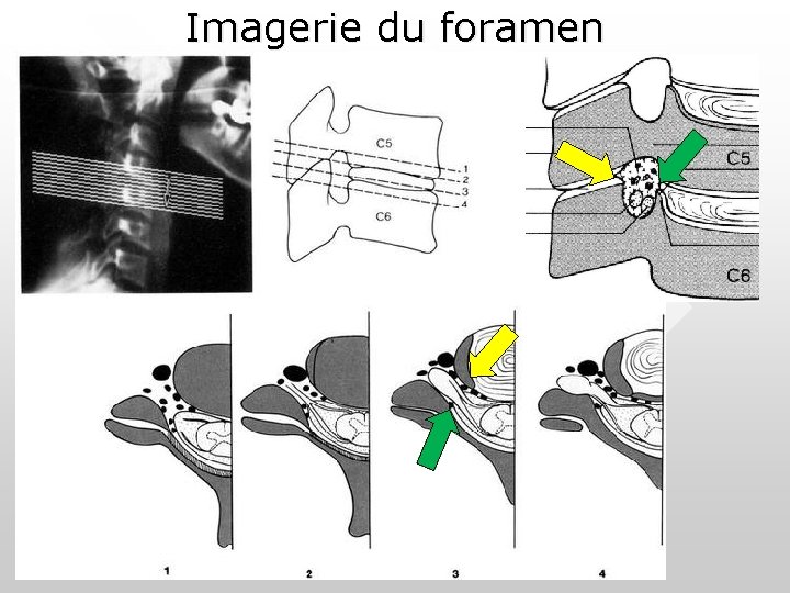 Imagerie du foramen Imagerie du foramen