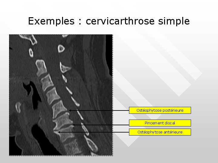 Exemples : cervicarthrose simple Ostéophytose postérieure Pincement discal Ostéophytose antérieure 