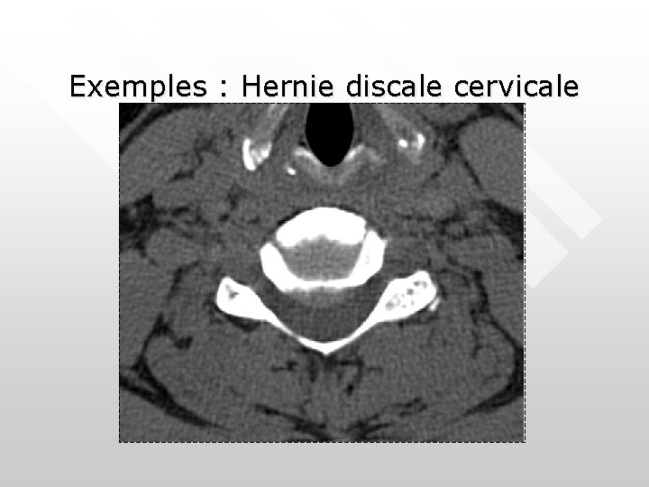 Exemples : Hernie discale cervicale Exemples : Hernie discale cervicale