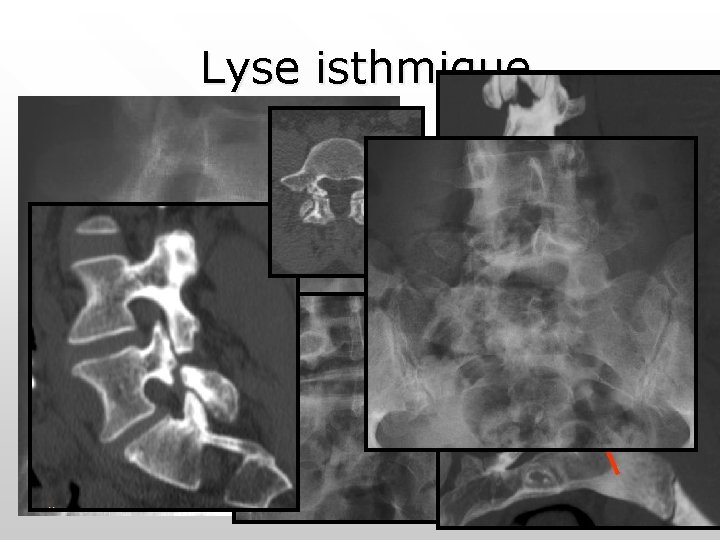Lyse isthmique Lyse isthmique