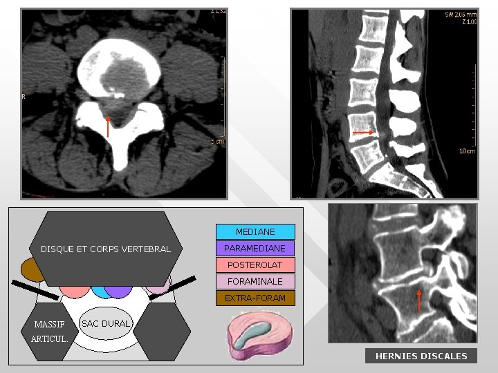 MEDIANE DISQUE ET CORPS VERTEBRAL PARAMEDIANE POSTEROLAT FORAMINALE EXTRA-FORAM MASSIF SAC DURAL ARTICUL. HERNIES