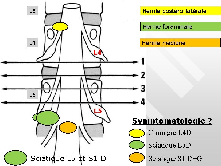 Hernie postéro-latérale L 3 Hernie foraminale L 4 Hernie médiane L 4 L 5