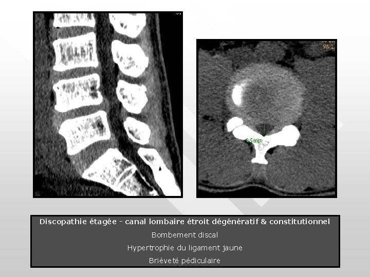 Discopathie étagée - canal lombaire étroit dégénératif & constitutionnel Bombement discal Hypertrophie du ligament