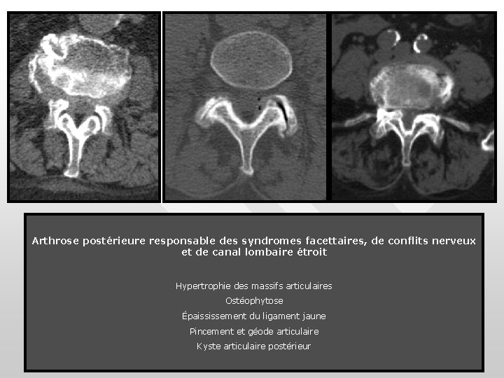 Arthrose postérieure responsable des syndromes facettaires, de conflits nerveux et de canal lombaire étroit