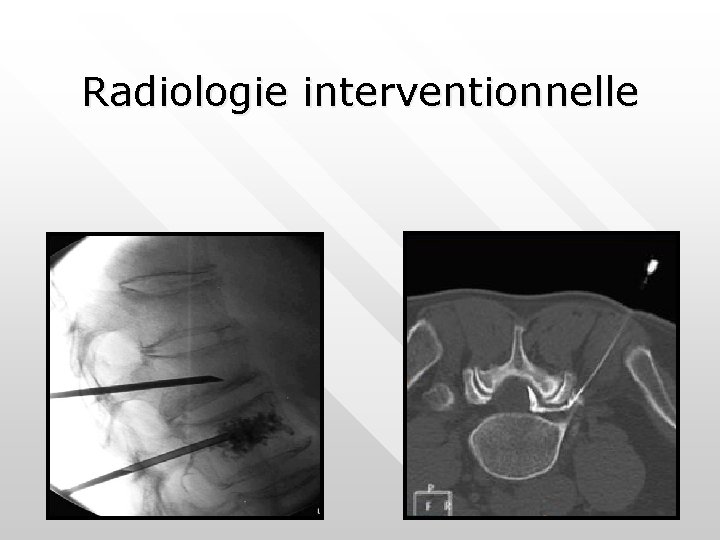 Radiologie interventionnelle Radiologie interventionnelle