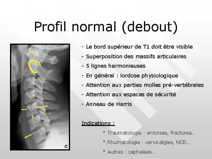 Profil normal (debout) - Le bord supérieur de T 1 doit être visible -