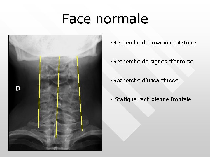 Face normale -Recherche de luxation rotatoire -Recherche de signes d’entorse -Recherche d’uncarthrose - Statique