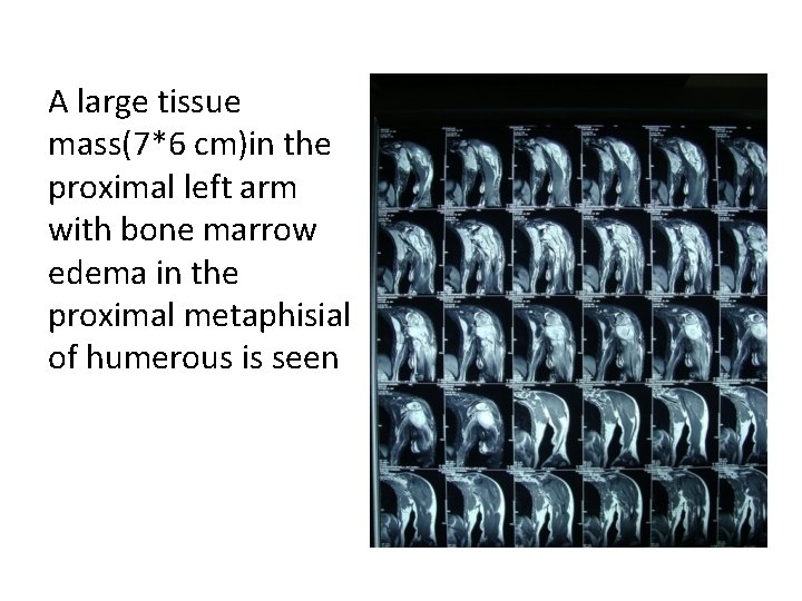 A large tissue mass(7*6 cm)in the proximal left arm with bone marrow edema in