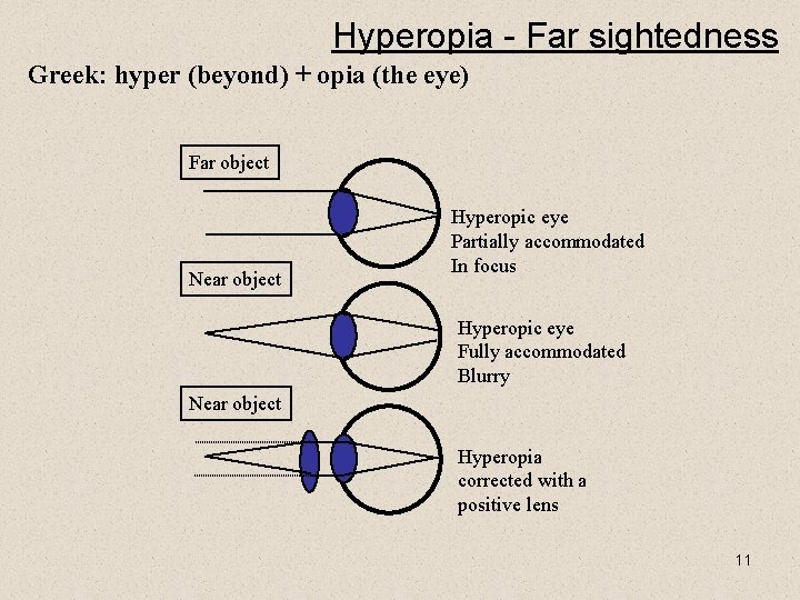 Hyperopia - Far sightedness Greek: hyper (beyond) + opia (the eye) Far object Near