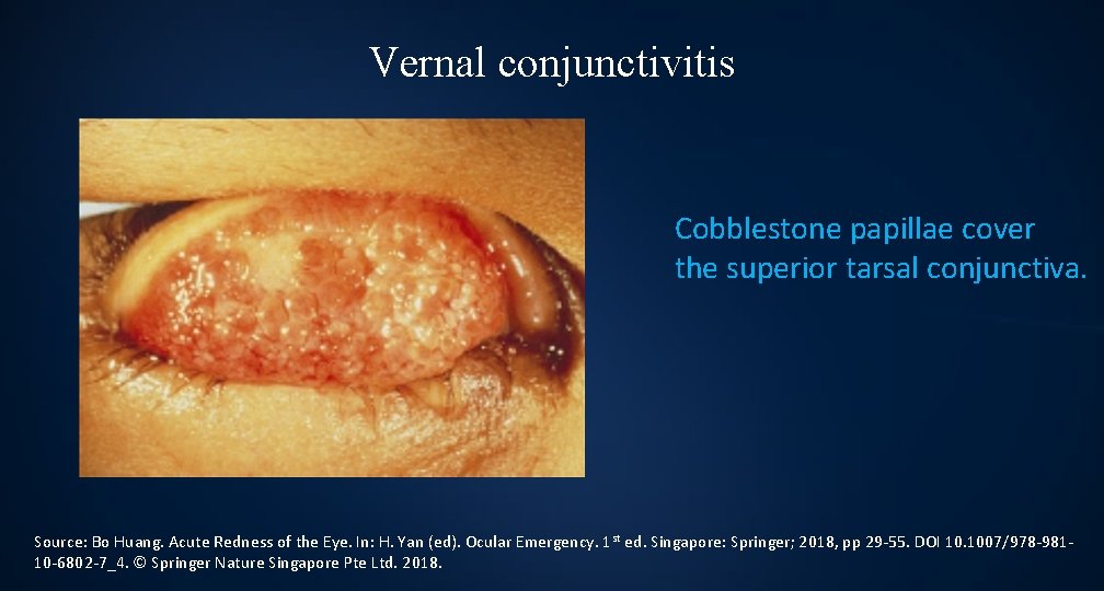 Vernal conjunctivitis Cobblestone papillae cover the superior tarsal conjunctiva. Source: Bo Huang. Acute Redness