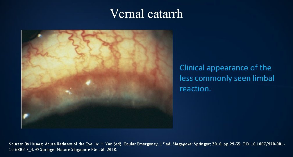 Vernal catarrh Clinical appearance of the less commonly seen limbal reaction. Source: Bo Huang.