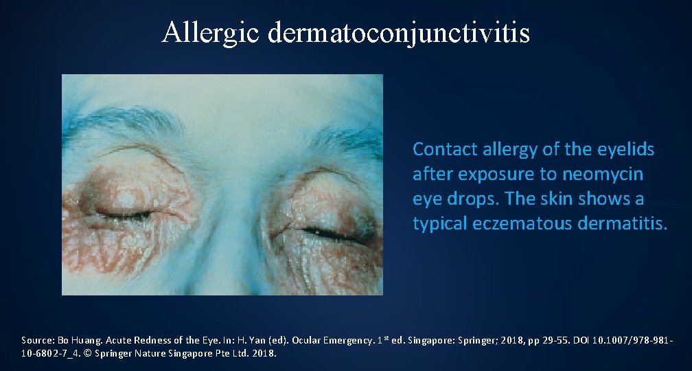 Allergic dermatoconjunctivitis Contact allergy of the eyelids after exposure to neomycin eye drops. The