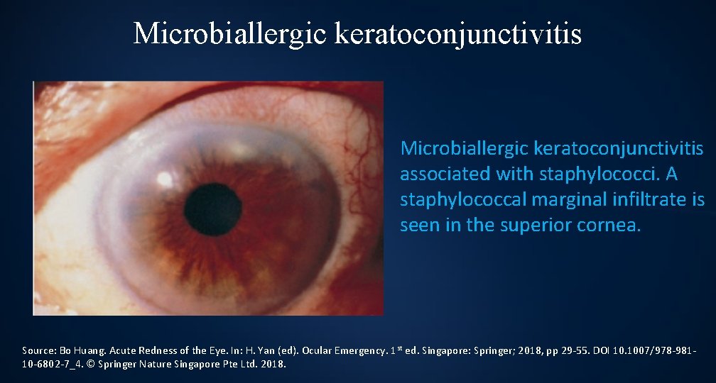 Microbiallergic keratoconjunctivitis associated with staphylococci. A staphylococcal marginal infiltrate is seen in the superior