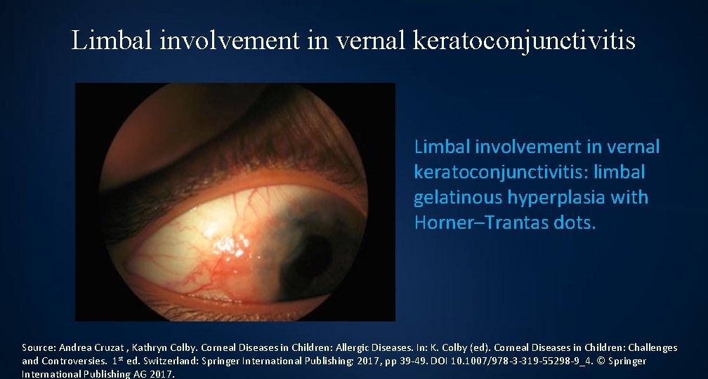 Limbal involvement in vernal keratoconjunctivitis: limbal gelatinous hyperplasia with Horner–Trantas dots. Source: Andrea Cruzat