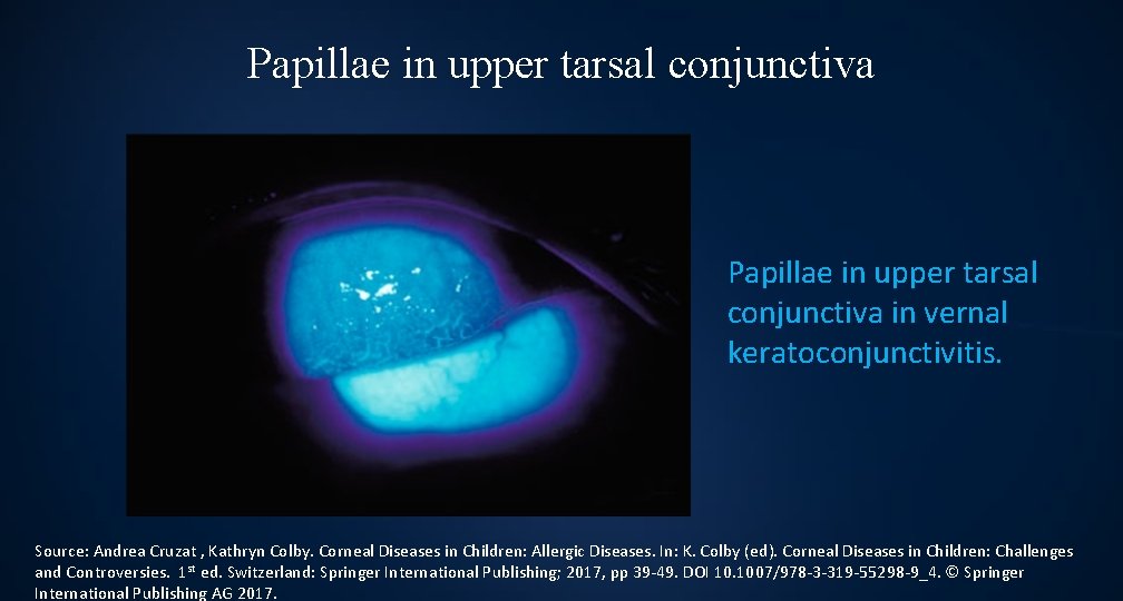 Papillae in upper tarsal conjunctiva in vernal keratoconjunctivitis. Source: Andrea Cruzat , Kathryn Colby.