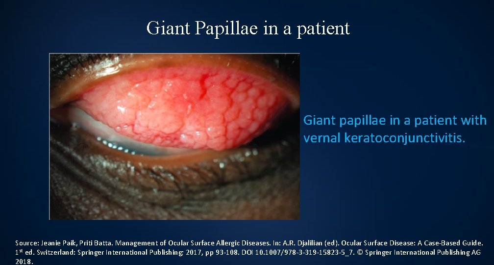 Giant Papillae in a patient Giant papillae in a patient with vernal keratoconjunctivitis. Source: