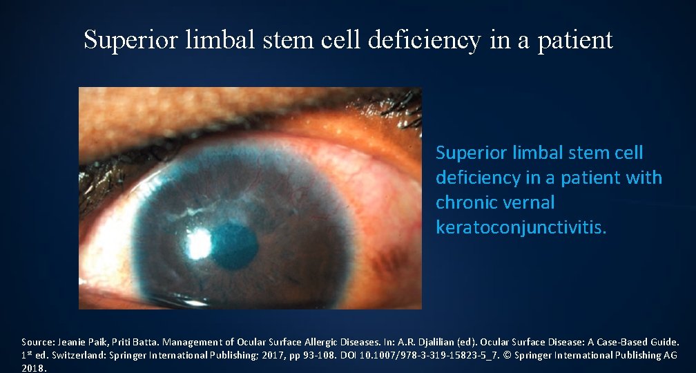 Superior limbal stem cell deficiency in a patient with chronic vernal keratoconjunctivitis. Source: Jeanie
