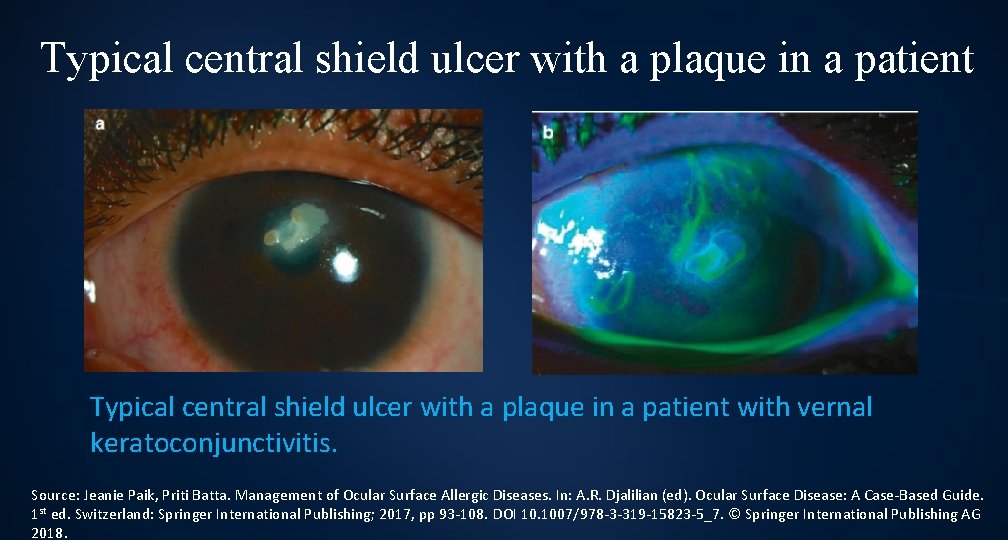 Typical central shield ulcer with a plaque in a patient with vernal keratoconjunctivitis. Source: