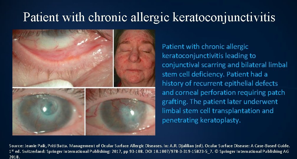 Patient with chronic allergic keratoconjunctivitis leading to conjunctival scarring and bilateral limbal stem cell