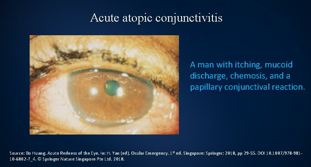 Acute atopic conjunctivitis A man with itching, mucoid discharge, chemosis, and a papillary conjunctival