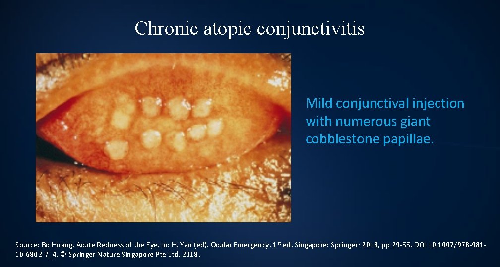 Chronic atopic conjunctivitis Mild conjunctival injection with numerous giant cobblestone papillae. Source: Bo Huang.