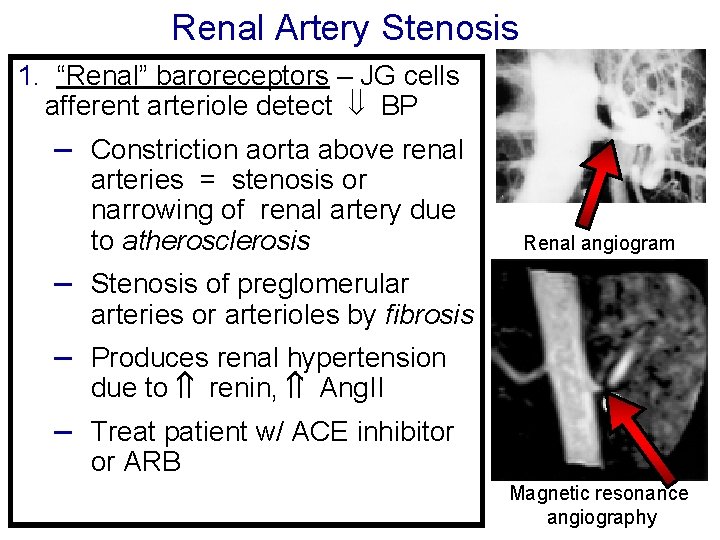 Renal Artery Stenosis 1. “Renal” baroreceptors – JG cells afferent arteriole detect BP –